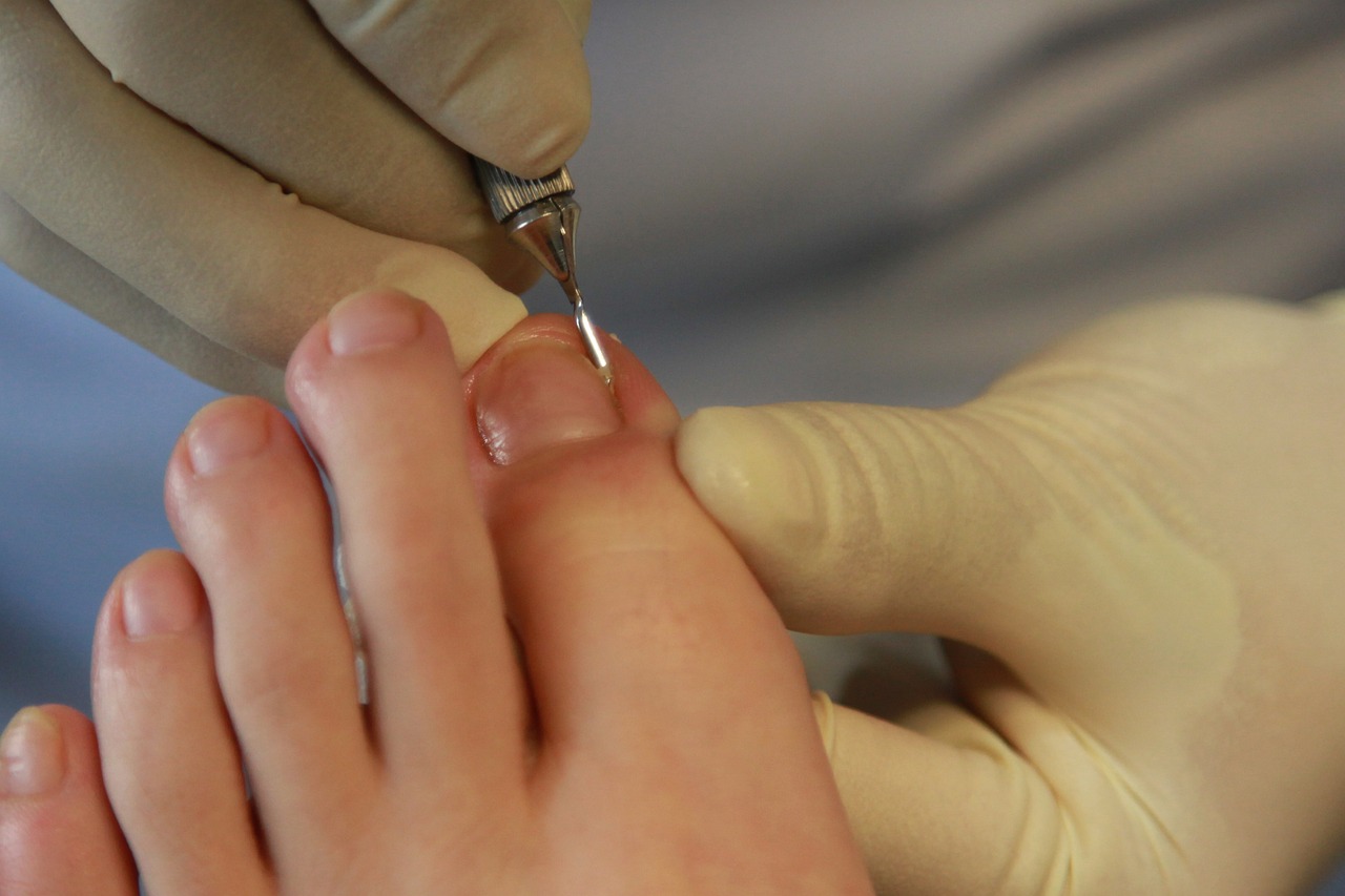 Advanced Treatments For Ingrown Toenails