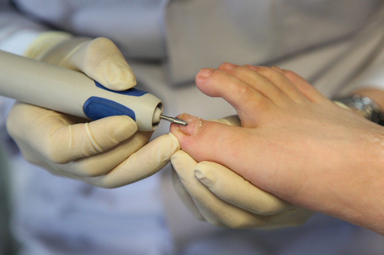 Understanding Treatments For Ingrown Toenail And Toenail Fungus