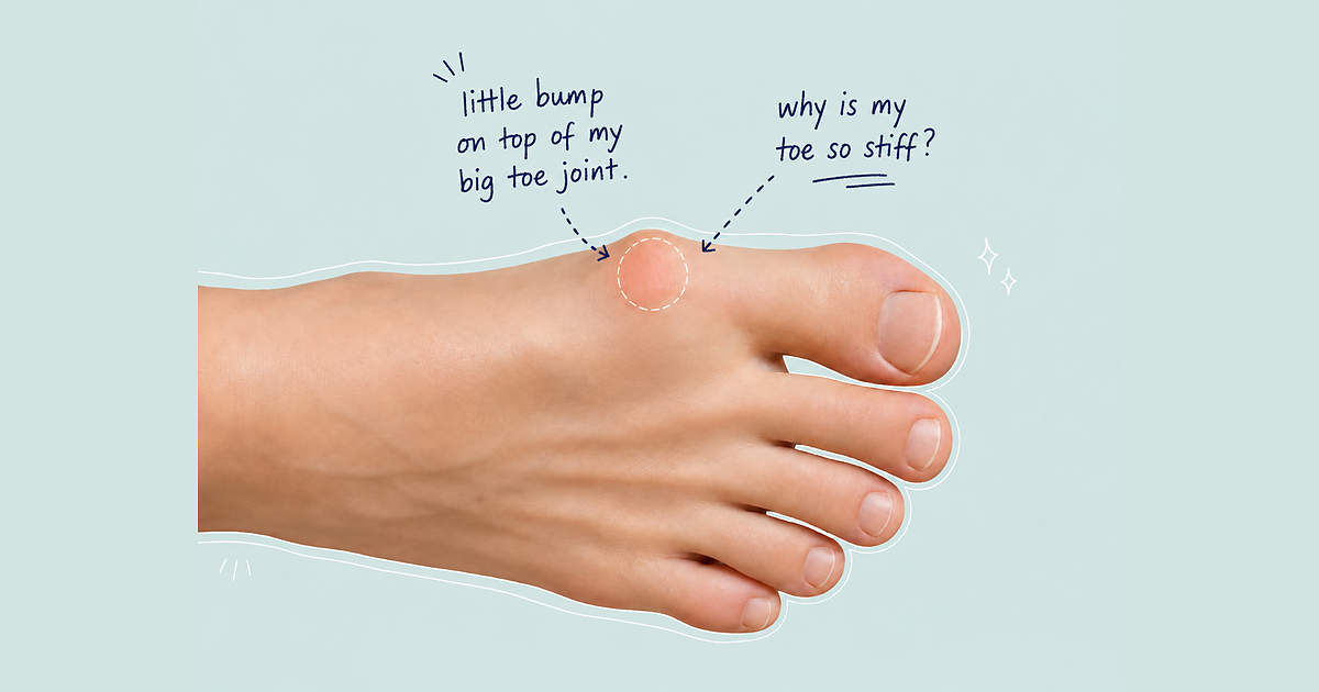 Close-up of a foot illustrating Hallux Rigidus symptoms, highlighting a stiff big toe joint and a small bump on top.