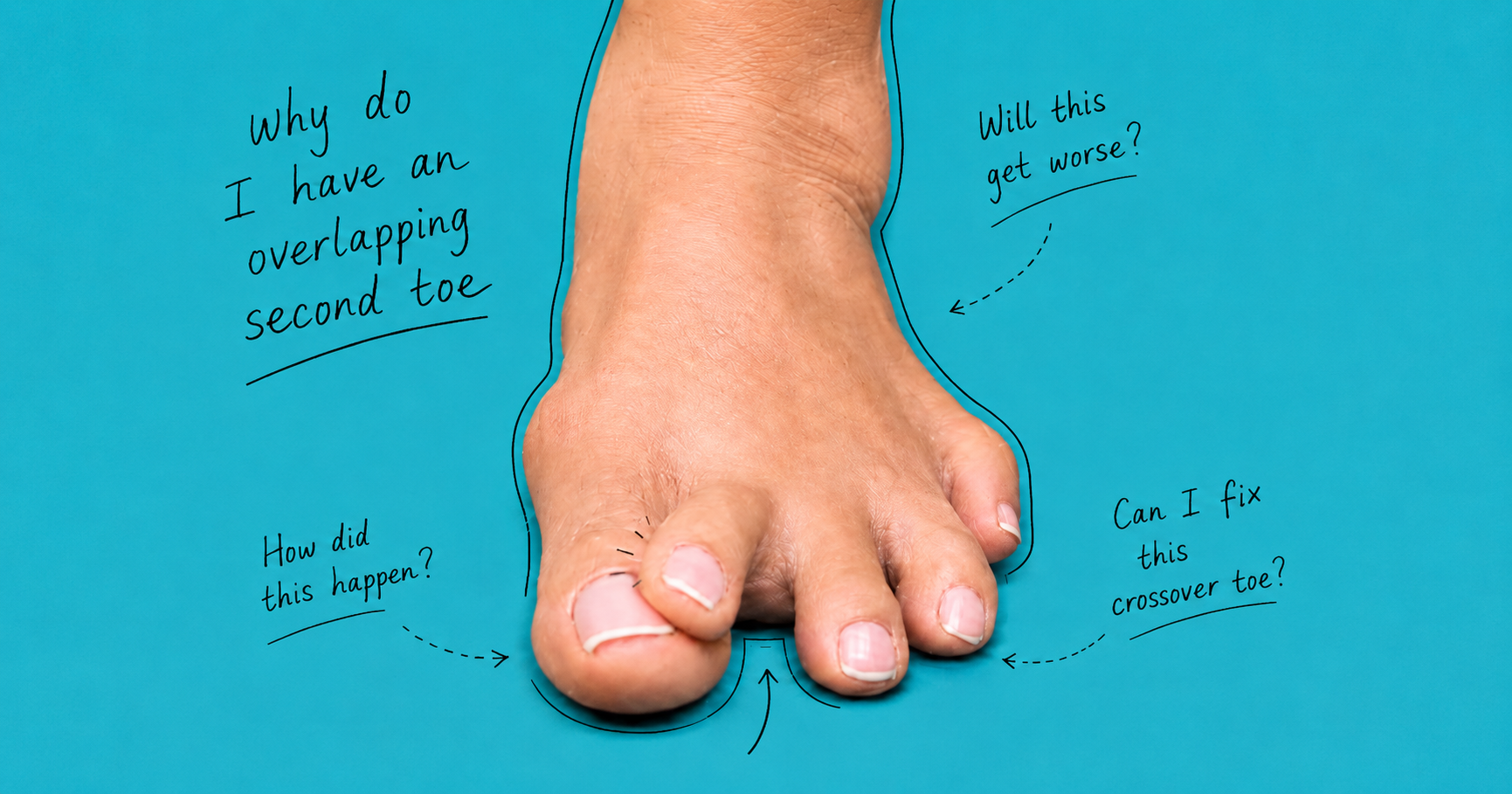Adult foot with an overlapping second toe and crossover toe deformity on a turquoise medical background, with black handwritten annotations asking “Why do I have an overlapping second toe?”, “Will this get worse?”, “How did this happen?” and “Can I fix this crossover toe?”