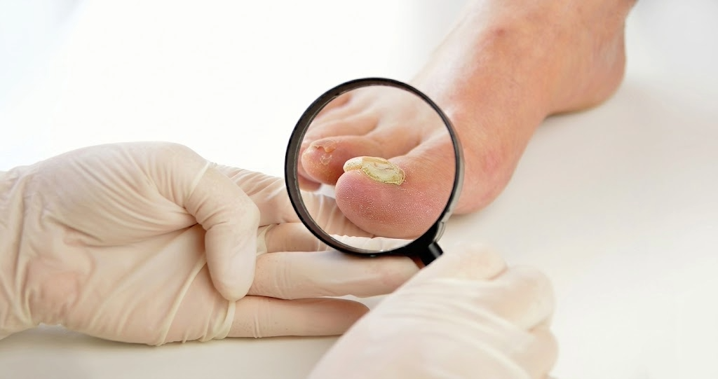 A podiatrist using a magnifying glass to examine a patient's big toe, showing clear symptoms of toenail fungus such as thickening and yellow discoloration.