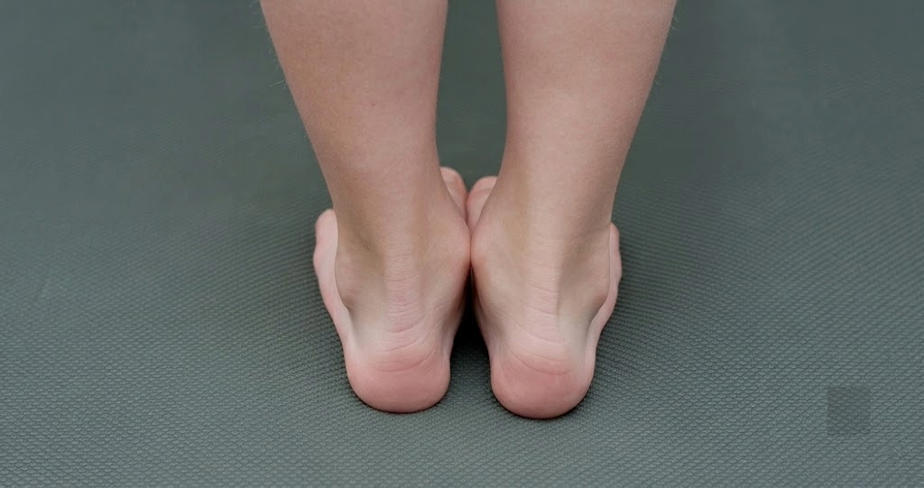 A close-up view from behind of a person's bare feet showing ankles rolling inward, illustrating the physical appearance of flat feet and overpronation as discussed in the guide on whether flat feet can be corrected.