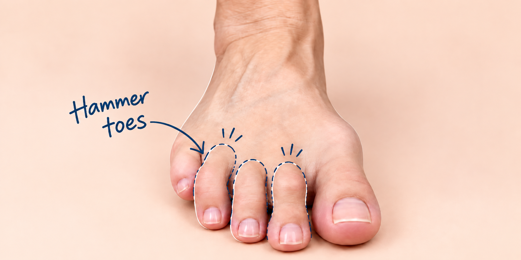 Close-up of a bare foot with hammer toes, highlighted by a navy blue hand-drawn arrow and outline annotations pointing to the curled middle toes on a soft beige background.