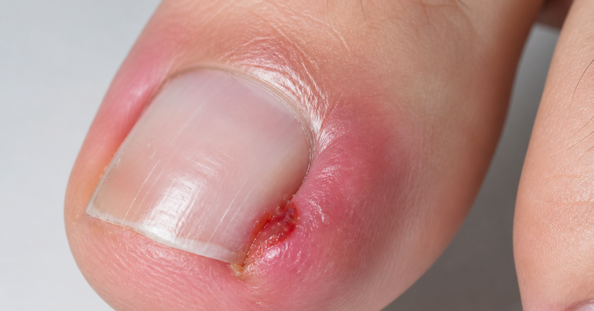 Ingrown Toenails - A Comprehensive Guide