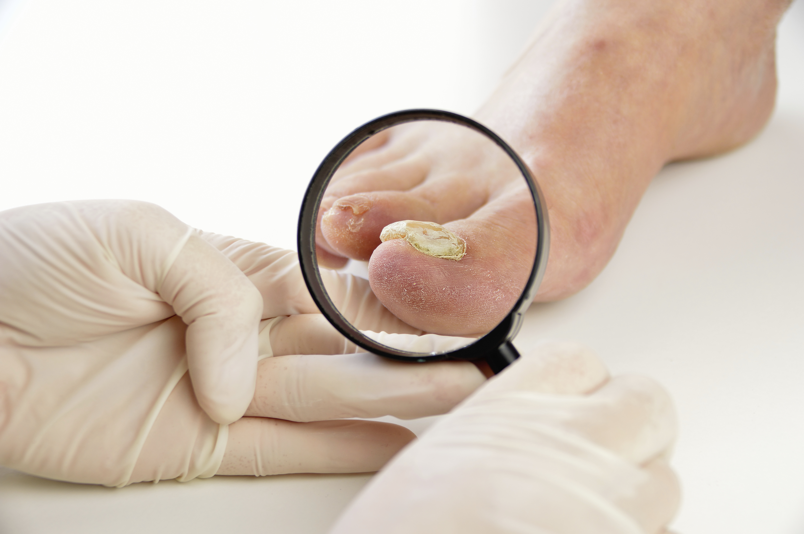 How Do I Know Whether I Have Nail Fungus?