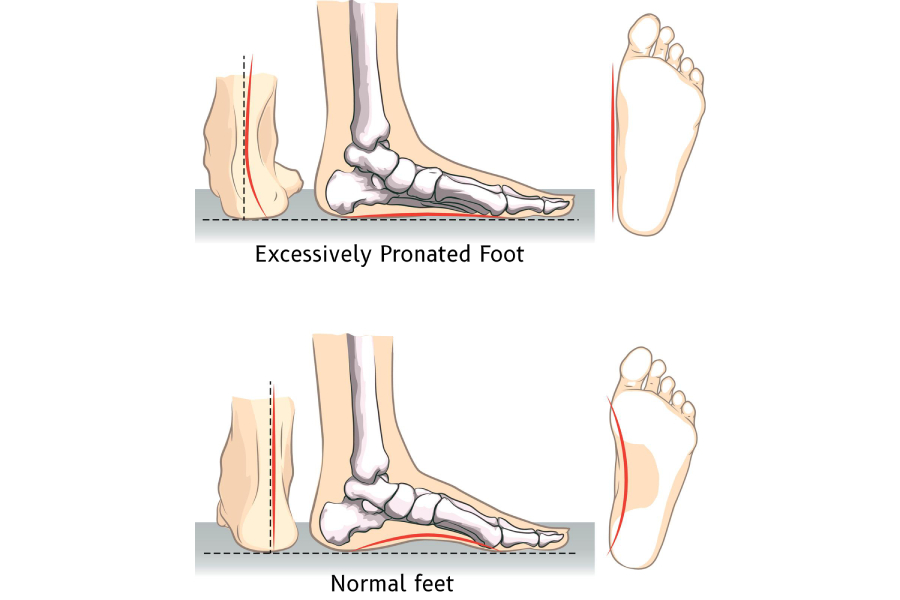 Signs of Overpronation or Supination in Your Feet