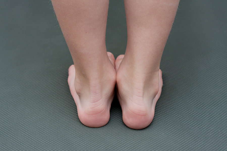 Can Flat Feet Be Corrected? 