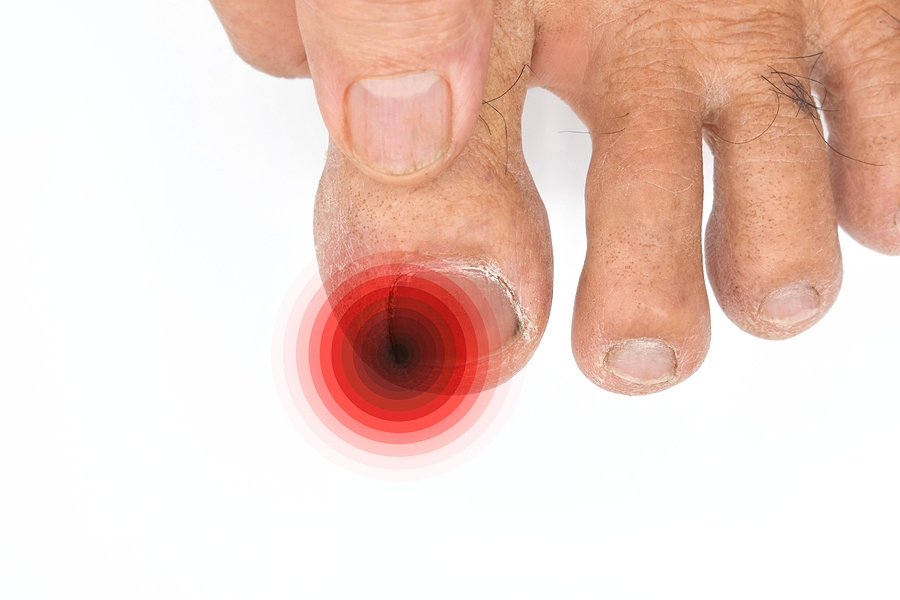 Chronic Paronychia: Why Does Your Toe Keep Getting Infected?