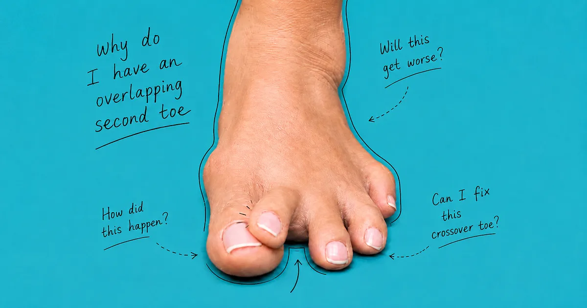 Adult foot with an overlapping second toe and crossover toe deformity on a turquoise medical background, with black handwritten annotations asking “Why do I have an overlapping second toe?”, “Will this get worse?”, “How did this happen?” and “Can I fix this crossover toe?”