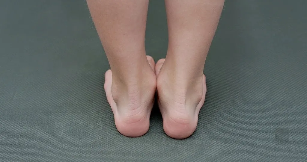 A close-up view from behind of a person's bare feet showing ankles rolling inward, illustrating the physical appearance of flat feet and overpronation as discussed in the guide on whether flat feet can be corrected.