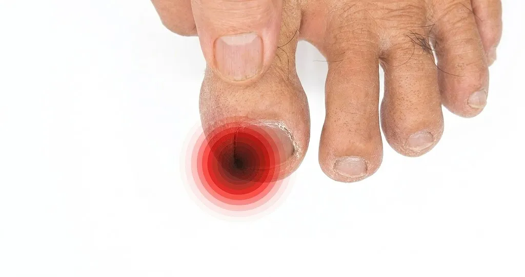 Close-up of a finger pointing to a big toe with a red graphic highlighting the infected nail fold, illustrating the pain of chronic paronychia and why your toe keeps getting infected.